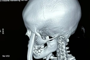 Báo động đỏ liên viện cứu bé gái bị tay thắng xe đạp đâm xuyên hốc mắt