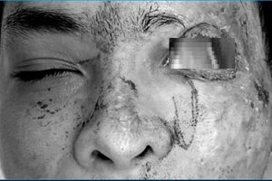 Khó khăn khi nhắm mở mắt sau tai nạn giao thông