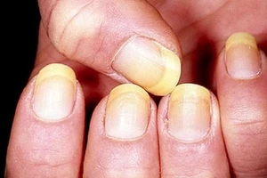 Màu sắc, hình dáng móng tay nói gì về sức khỏe của bạn?