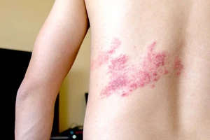 Bệnh zona dễ nhầm lẫn với bệnh nào?
