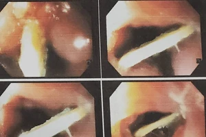 Liên tục các ca hóc dị vật ở người lớn tuổi