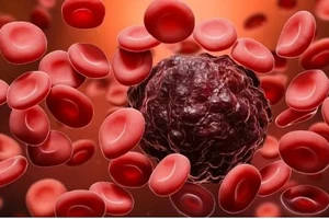 Ung thư máu (Ảnh: Internet)