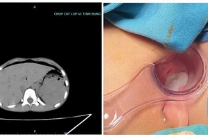 Bé trai 8 tuổi thủng trực tràng do ngồi vào bút bi dựng ngược