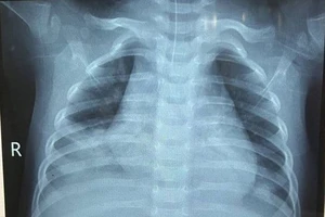 Uống dầu hỏa, bé trai 14 tháng tuổi nguy kịch