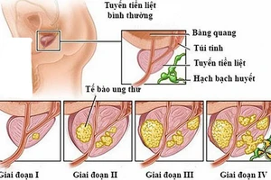 Ung thư tuyến tiền liệt sống được bao lâu?