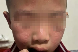 Nhiều học sinh dị ứng, sưng mắt sau khi trường phun thuốc diệt muỗi