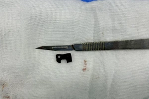 Hi hữu: Mắt xích máy cưa trong ổ bụng thanh niên suốt 2 tuần