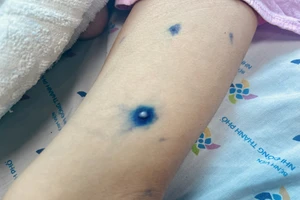 Bị bệnh thủy đậu 1 lần sao vẫn mắc lại?