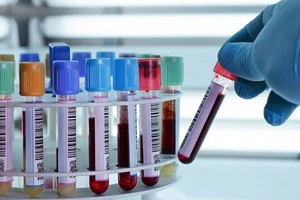Xét nghiệm máu có nhất thiết phải nhịn ăn?