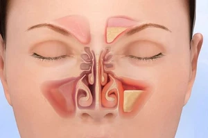 Xông lá trị dứt được bệnh viêm xoang không?