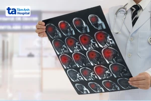 8 dấu hiệu ung thư não giai đoạn đầu