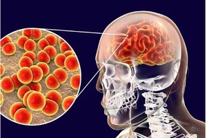 Những điều cần biết về bệnh do não mô cầu