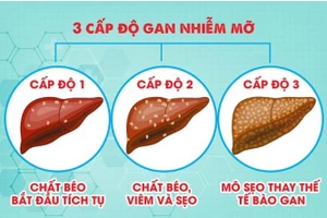 Gan nhiễm mỡ có mấy cấp độ, độ 2 đã nặng chưa?