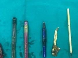 Thủng đại tràng do ăn bật lửa, kim loại, bút bi...