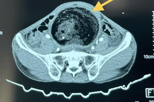 Khối phân tích tụ lâu năm khiến người đàn ông phải cắt đại tràng