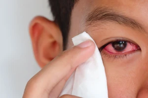 Có nên dùng lá trầu không chữa đau mắt đỏ?