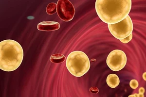 Tại sao ‘gầy như que củi’ mà vẫn bị mỡ máu cao?