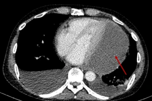 14 ngày giành sự sống cho người bệnh tràn mủ màng ngoài tim hiếm gặp 