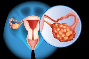 Ung thư buồng trứng có di truyền không?