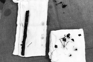 Hi hữu: Bé gái 3 tuổi mang cành cây dài 16 cm trong bụng suốt 4 tháng