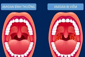Viêm amidan, làm thế nào để tránh tái phát?