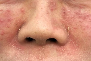  Làm đẹp cấp tốc đón Tết, nhiều người 'tiền mất tật mang'