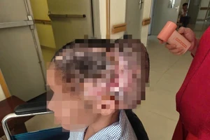 Cô gái biến chứng khuyết sọ sau cấy mỡ tự thân vào thái dương