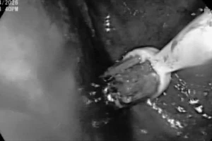 Nam thanh niên nuốt 3 bàn chải đánh răng