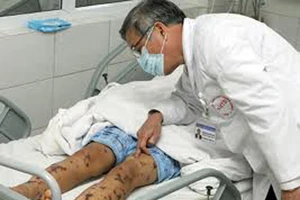 Cục Y tế dự phòng cảnh báo bệnh viêm não mô cầu