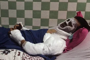 Việt kiều bị tạt a xít ở Quảng Ngãi bị cháy giác mạc