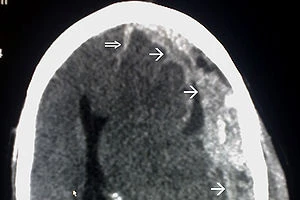 1 Phó công an phường chấn thương sọ não tại quán Karaoke