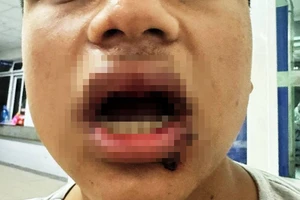 Xác định được nhóm người hành hung, làm gãy 4 cái răng của nam sinh