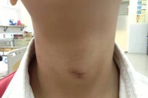 Bé trai 7 tuổi suýt chết vì bị rèm cửa lớp thít cổ