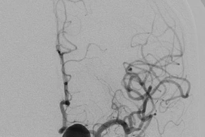 Kỹ thuật mới, cứu bệnh nhân có mạch máu não phình to suýt vỡ