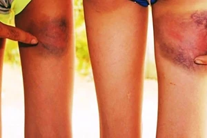 Thầy giáo đánh bầm tím 6 HS: Kỷ luật ở mức cao nhất