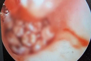 Hàng chục con giòi bên trong tai của bệnh nhân