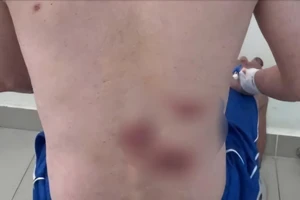 Nam thanh niên mắc giang mai, lở loét hết lưng