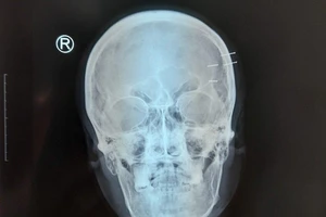 Tự bắn 4 cây đinh vào hộp sọ để giải sầu