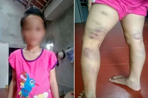 Học sinh lớp 2 bị cô giáo đánh tím đùi vì viết sai chính tả