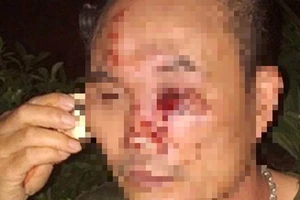 Bảo vệ chung cư bị côn đồ hành hung nhập viện