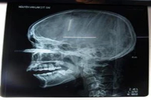 Kinh hoàng: Lưỡi cưa đâm vào mặt, nam thanh niên suýt mù mắt