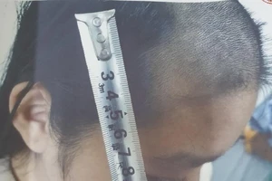 Cha nghiện ma túy, bạo hành dã man con gái 15 tuổi