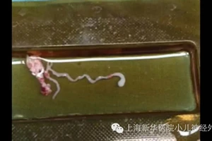 Sán dài 8 cm làm tổ trong não vì thức ăn đường phố