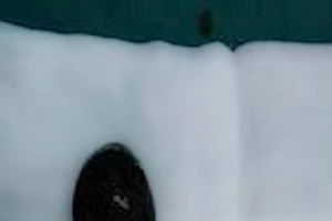 Phẫu thuật lấy viên sỏi thận to như trứng gà