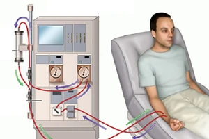Bệnh nhân chạy thận nhân tạo dễ gặp những rủi ro nào?
