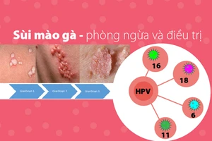 Từ vụ gần 80 trẻ mắc sùi mào gà: phòng ngừa và điều trị