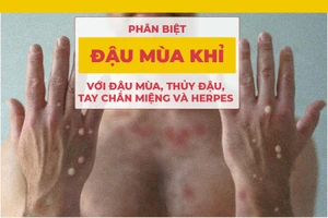 Phân biệt đậu mùa khỉ với đậu mùa, thủy đậu, tay chân miệng và herpes