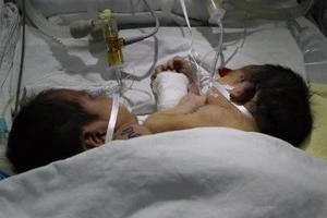 Hai bé sơ sinh dính liền ở Hà Giang đã mất