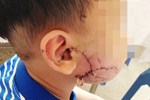 Trẻ ba tuổi bị chó berger cào cắn nát mặt