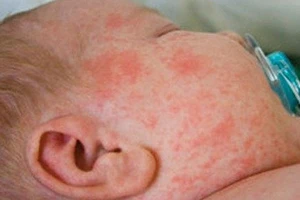 Trị sởi bằng Đông y